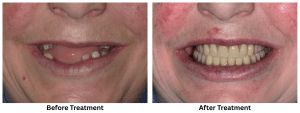 Before & After Photos of Denture Treatment